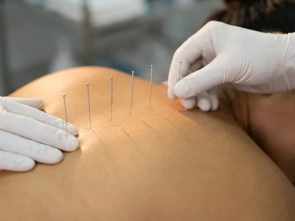 Θεραπευτικός βελονισμός για ανακούφιση πόνου