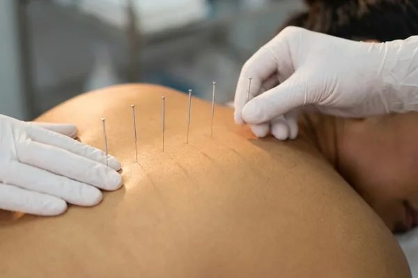 Θεραπευτικός βελονισμός για ανακούφιση πόνου